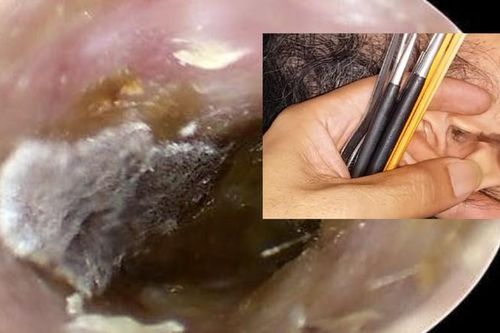 Rước họa vì lấy ráy tai ở quán cắt tóc, gội đầu vỉa hè