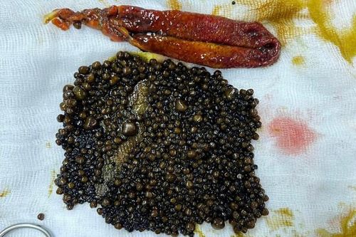 Hơn 1.100 viên sỏi trong túi mật người phụ nữ