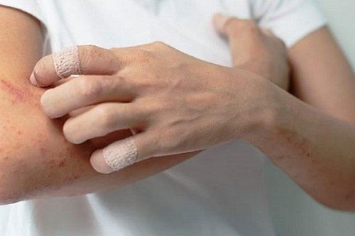 Lupus ban đỏ - Bệnh tự miễn khó trị