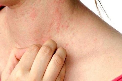 Người phụ nữ mắc chứng dị ứng với bạn trai