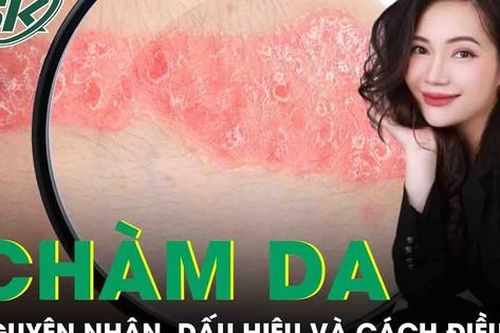 Chàm da: Cách điều trị thế nào? Có chữa khỏi được không?
