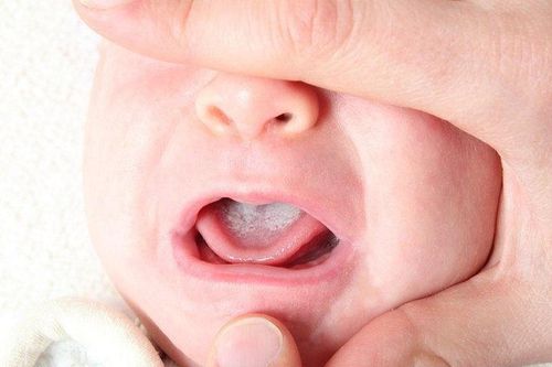 Nguyên nhân khiến trẻ bị tưa miệng