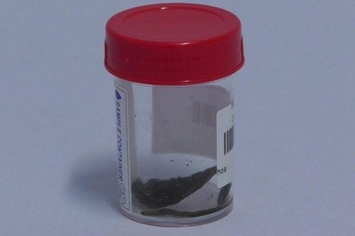 Xương cá đâm thủng trực tràng bệnh nhân