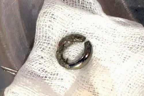 Bé trai 27 tháng tuổi nuốt móc khóa