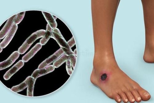 Bệnh than là gì? Triệu chứng nguyên nhân và cách điều trị bệnh than
