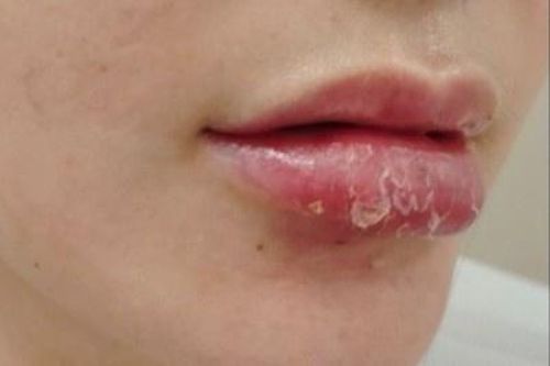 Cô gái 25 tuổi nhập viện với đôi môi sưng phù sau tiêm filler