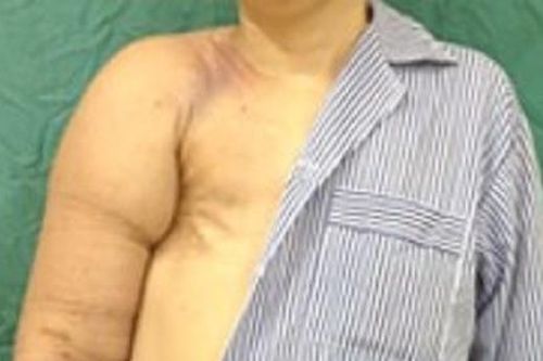 Cánh tay sưng to sau khi điều trị ung thư