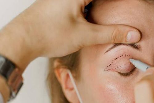 Người phụ nữ bị sót chỉ khâu trên mặt sau khi làm đẹp hết 60 triệu đồng