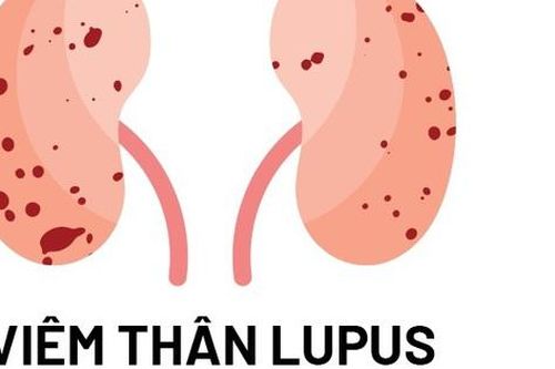 Bước ngoặt mới cho bệnh nhân viêm thận lupus