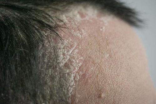 Nấm da đầu có chữa dứt điểm được không?