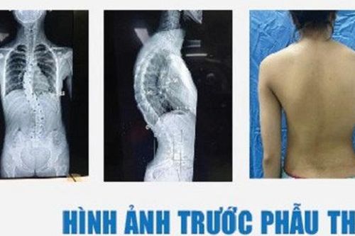 Hành trình tìm lại dáng vóc cho nữ sinh 15 tuổi bị vẹo cột sống do ngồi học sai tư thế