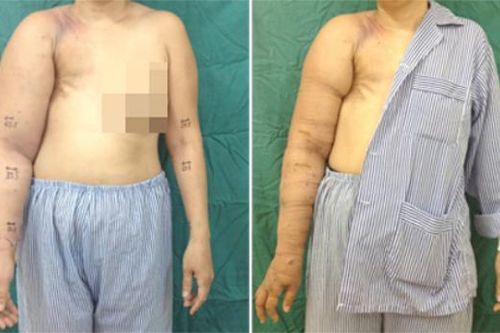 Căn bệnh khiến người phụ nữ 25 năm khổ sở muốn cắt bỏ cánh tay