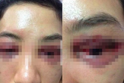 Cô gái 20 tuổi hỏng mắt sau cắt mí tại một Spa