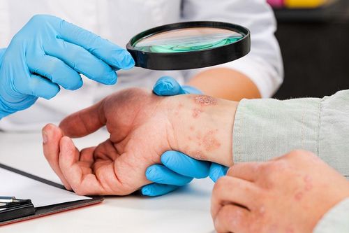 Biến chứng của bệnh viêm da cơ địa