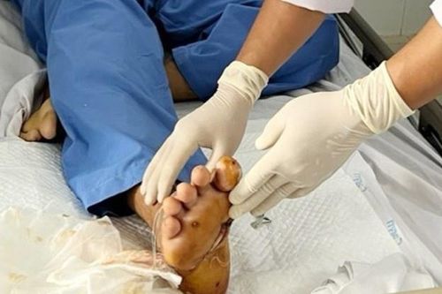 Người đàn ông nhập viện với bàn chân bị đứt lìa