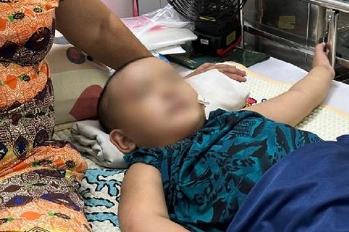 2 bệnh nhi mắc chứng động kinh co giật nửa người