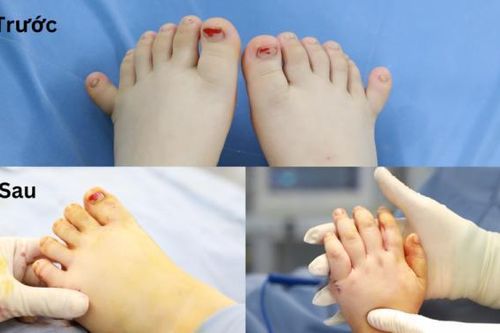 Phẫu thuật thành công cho em bé có đến 24 ngón tay chân hiếm gặp