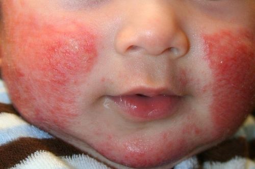 Trẻ bị viêm da cơ địa nên mặc như thế nào?