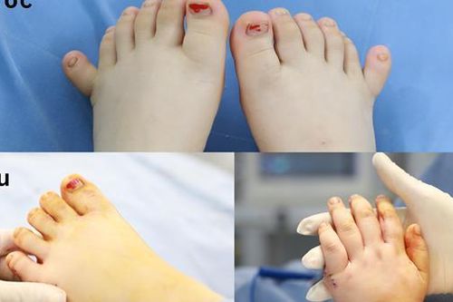 Phẫu thuật thành công cho bé dị tật ngón tay, chân