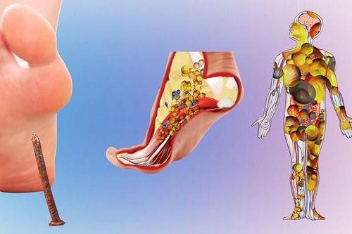 Vết thương nhỏ cũng có thể gây uốn ván