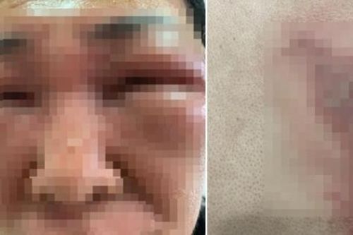 Bóp chết côn trùng rồi quẹt tay lên mặt, hai vợ chồng không mở nổi mắt