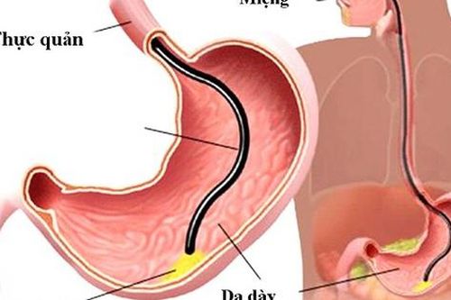 Nội soi tiêu hóa cho trẻ cần chú ý những gì?