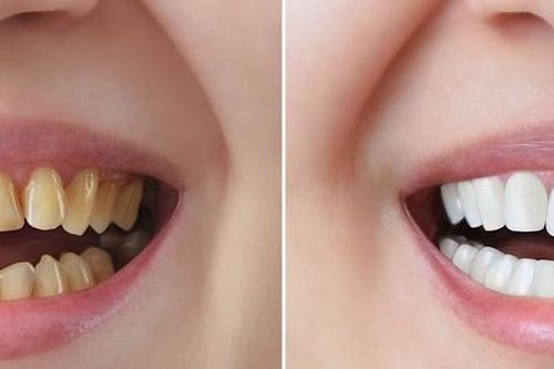 Nên chọn phương pháp bọc răng sứ nào?