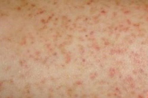 Mắc sốt xuất huyết hết sốt đã khỏi bệnh chưa?