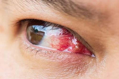 Đau mắt đỏ có thể để lại sẹo