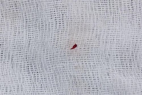 Suýt mất mạng vì dùng kim chọc các đầu ngón tay loại bỏ máu độc