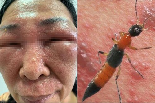 Mặt sưng húp, không thể mở mắt do nhiễm độc tố kiến ba khoang
