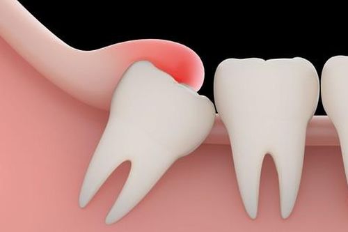 Khi nào cần nhổ răng khôn?