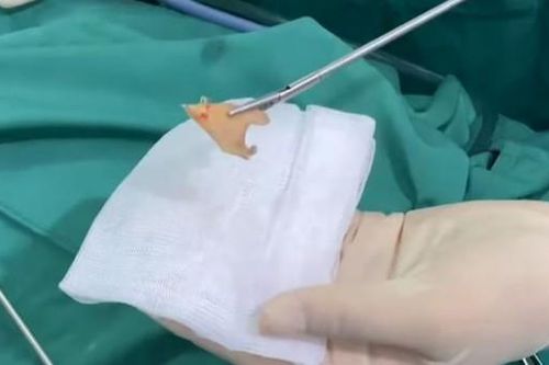Hóc xương lợn 3 cạnh do bất cẩn trong lúc ăn cơm