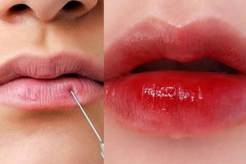 Từ vụ tắc mạch máu do tiêm filler môi, chuyên gia khuyến cáo điều quan trọng