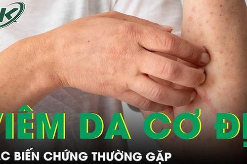 Biến chứng của viêm da cơ địa