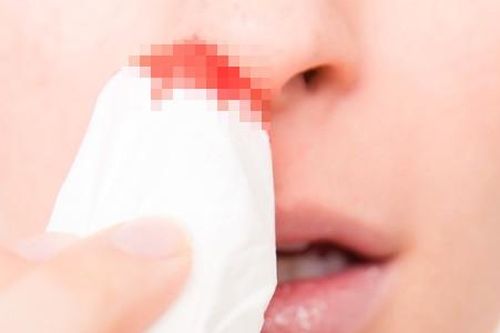 Chuyên gia Nhi 'mách' 5 bước xử trí khi trẻ bị chảy máu cam