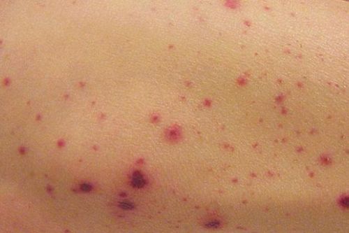 Xuất huyết giảm tiểu cầu có chữa khỏi không và cần làm xét nghiệm gì?