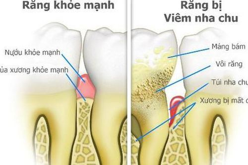Vệ sinh răng miệng tốt giúp bảo vệ não khỏi chứng mất trí nhớ