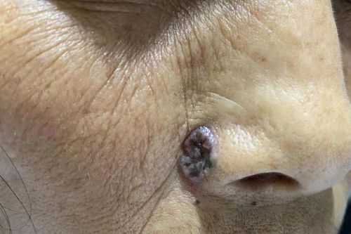 Không nên chủ quan với nốt ruồi có dấu hiệu 'lạ'