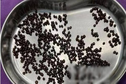 Đau bụng nửa năm, đi khám phát hiện điều kinh dị