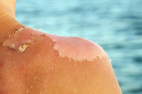 Cháy nắng có thể gây hại tới sức khỏe nghiêm trọng tới mức nào?