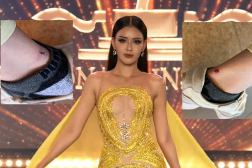 Đại diện Việt Nam tại Miss Supranational gặp sự cố, xót xa cho đôi chân sưng vù!