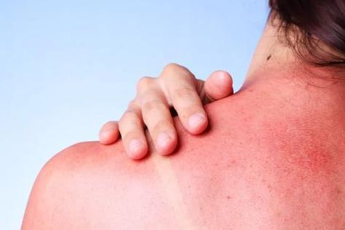 Cách khắc phục làn da bị cháy nắng dưới trời nắng nóng
