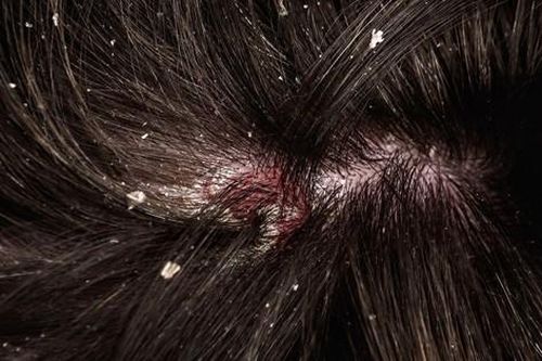 Gợi ý cách chọn dầu gội cho người bị nấm da đầu