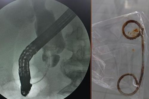 Nam bệnh nhân bỏ quên stent trong đường mật suốt 2 năm