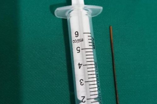 Thanh niên bị thủng ruột sau 6 tháng nuốt tăm tre