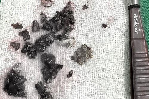 Người phụ nữ có khối sỏi lớn trong mũi suốt 30 năm