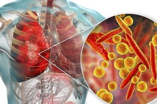Cảnh báo nhiều trẻ bị viêm phổi do vi khuẩn nguy hiểm