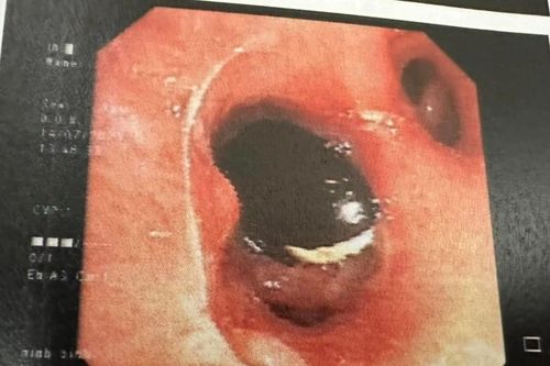 Dị vật mắc kẹt trong phổi giống hình ảnh 'cá voi sát thủ'