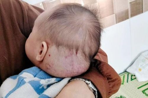 Trẻ 9 tháng tuổi 'đeo' khối u hỗn hợp lớn vùng đầu gáy